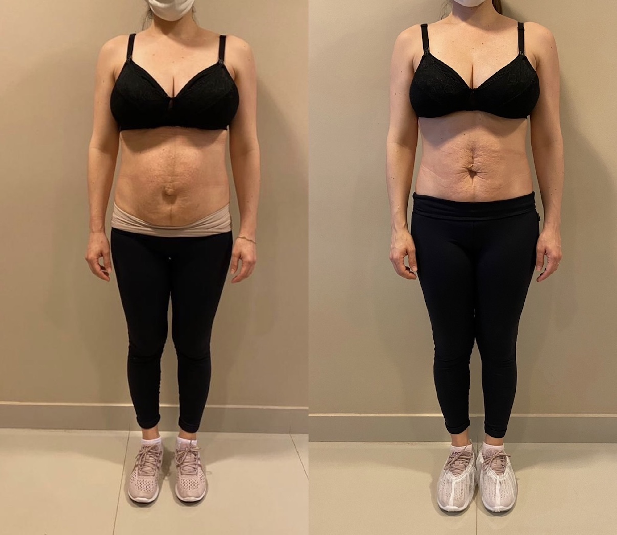 Antes e depois — hérnia umbilical pós-parto resolvida sem cirurgia