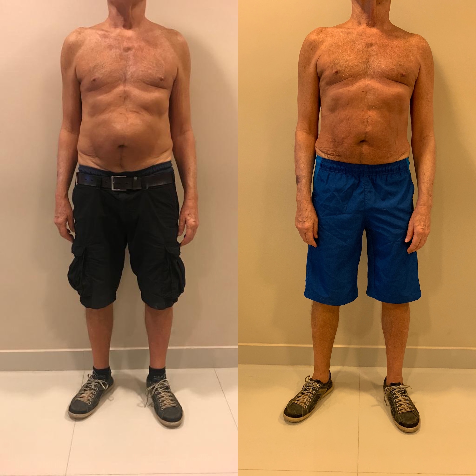 Antes e depois — regressão de hérnia epigástrica sem cirurgia
