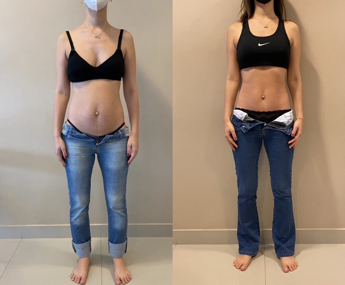 Antes e depois — hérnia umbilical, umbigo reposicionado sem bisturi
