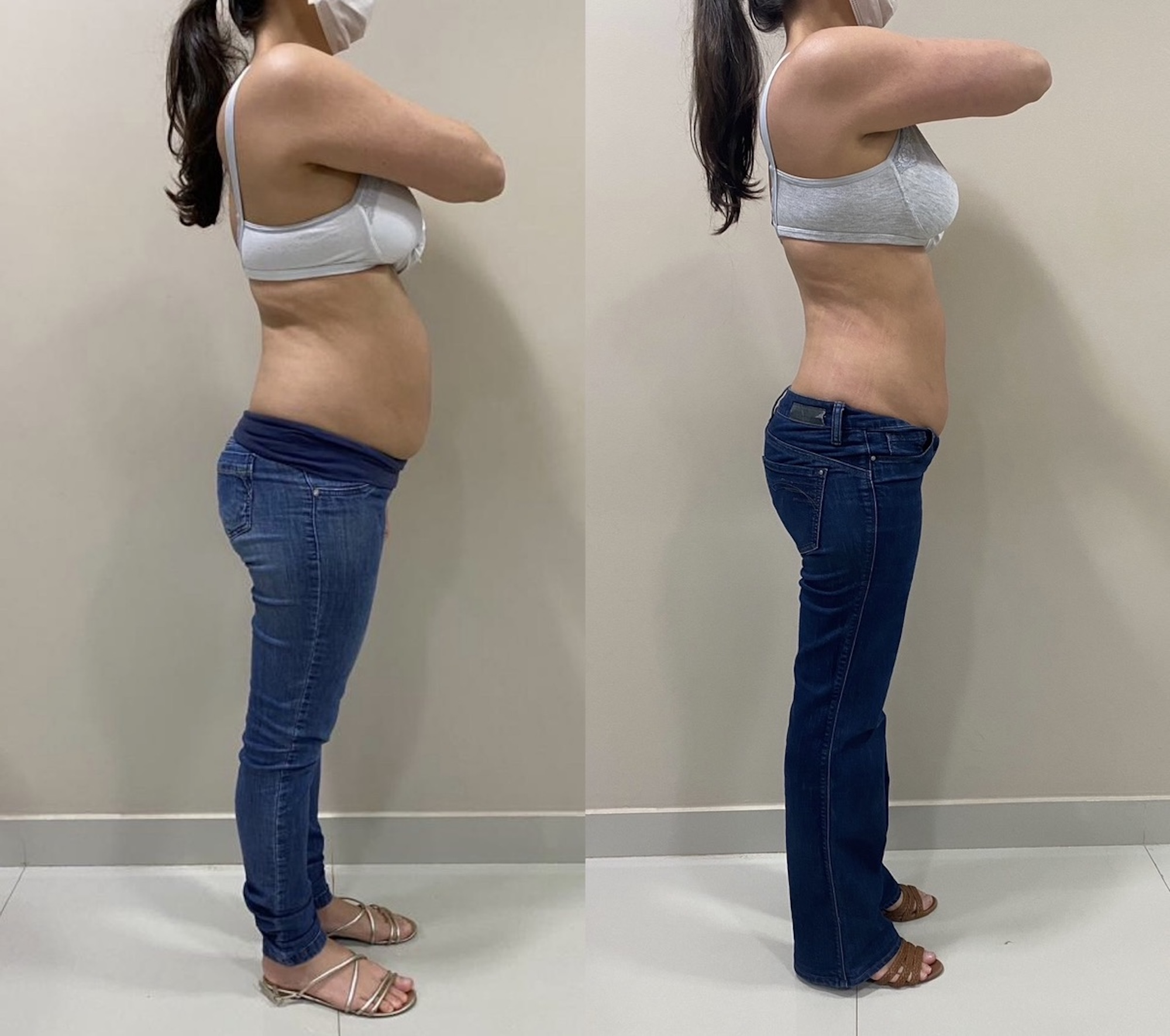 Antes e depois — volume abdominal reduzido