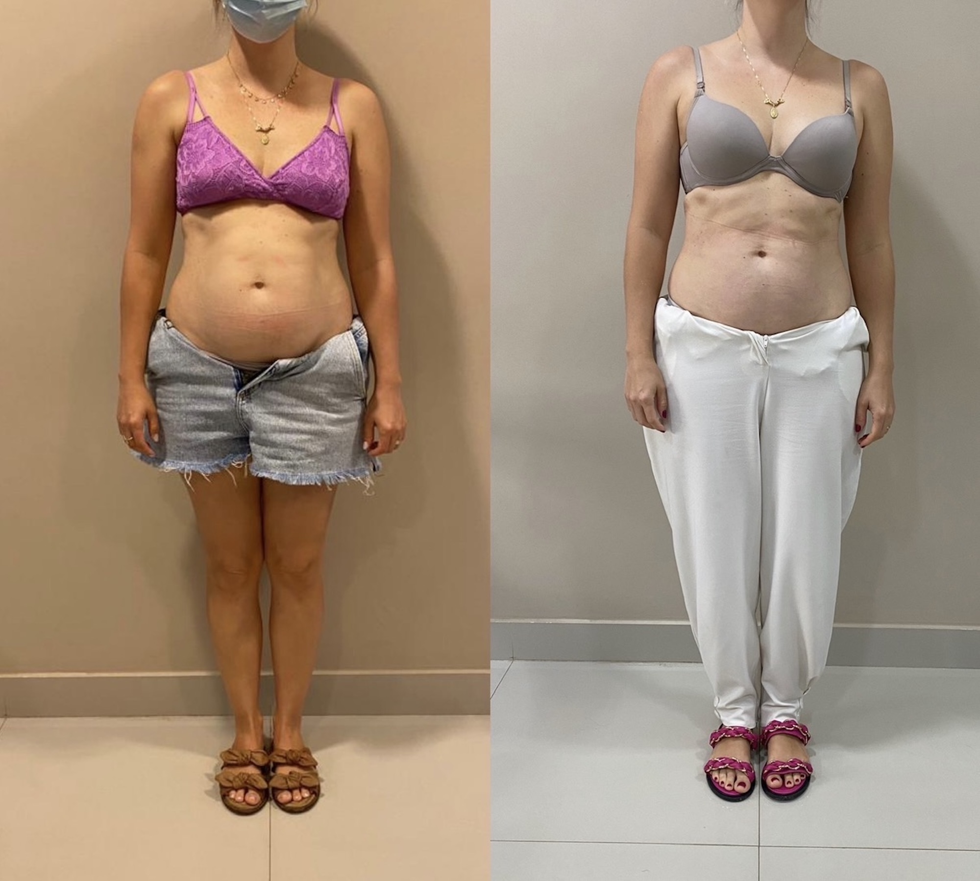 Antes e depois — diástase discreta