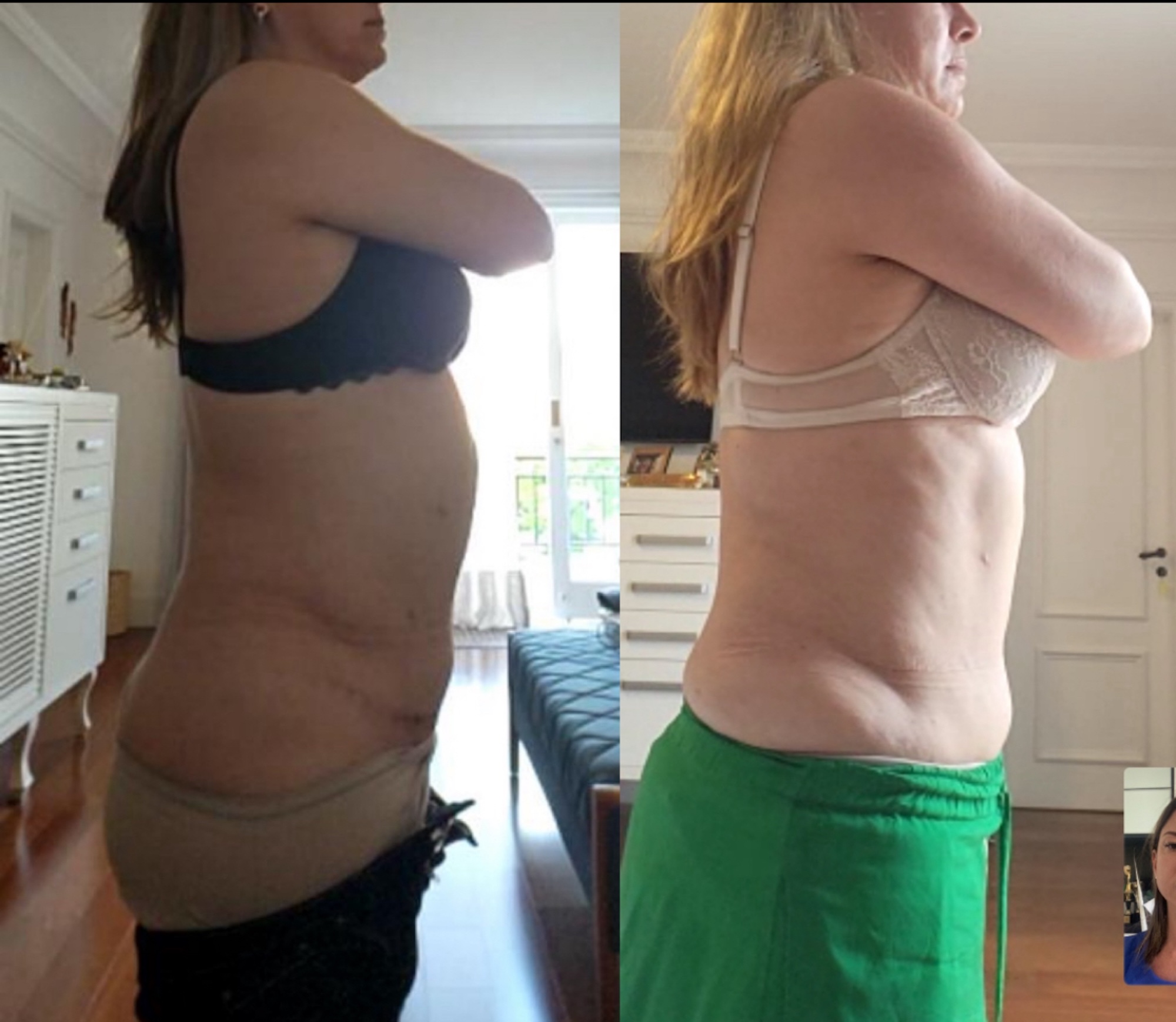 Antes e depois de abdominoplastia — vista lateral