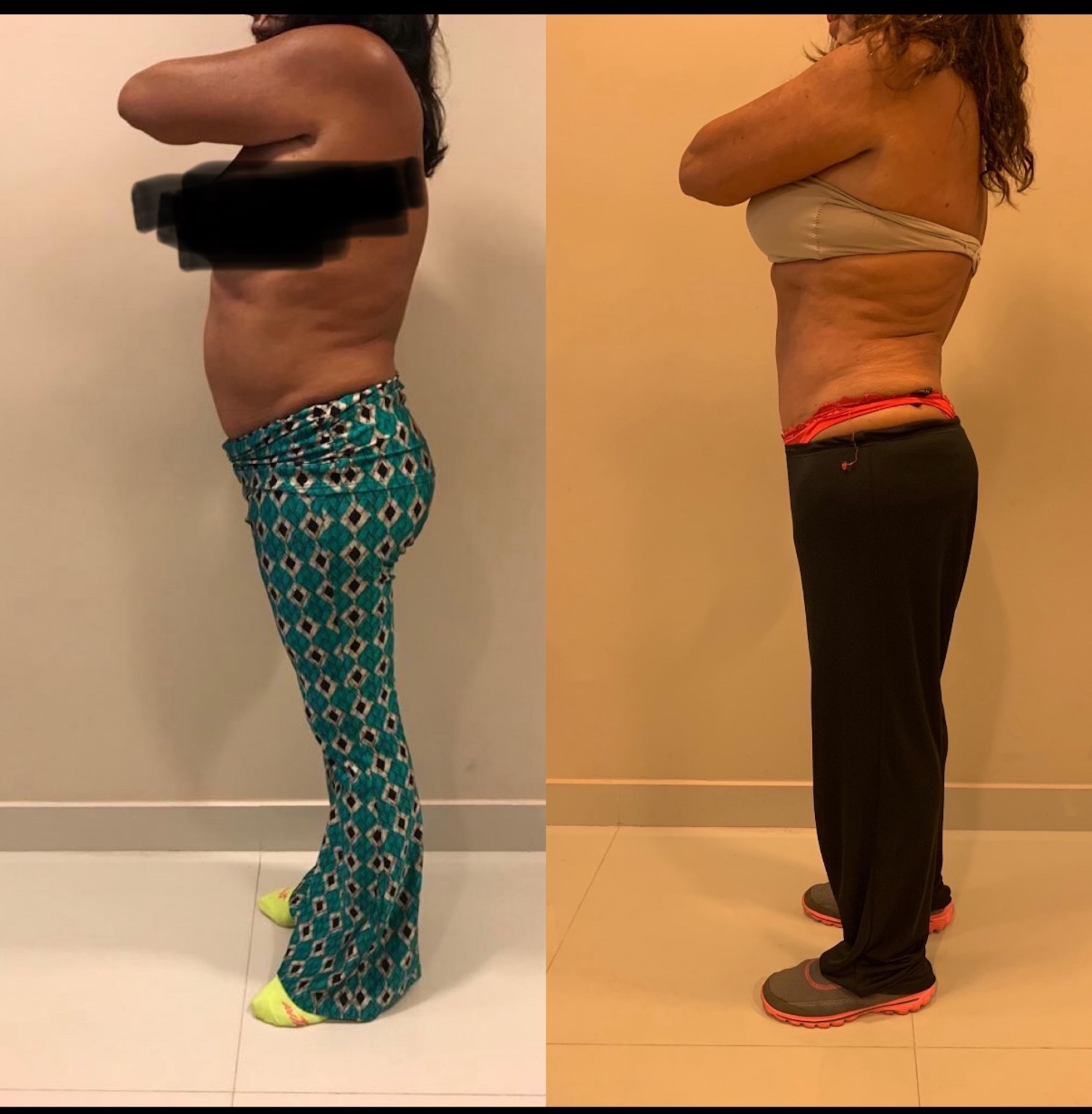 Antes e depois de cirurgia abdominal — vista lateral